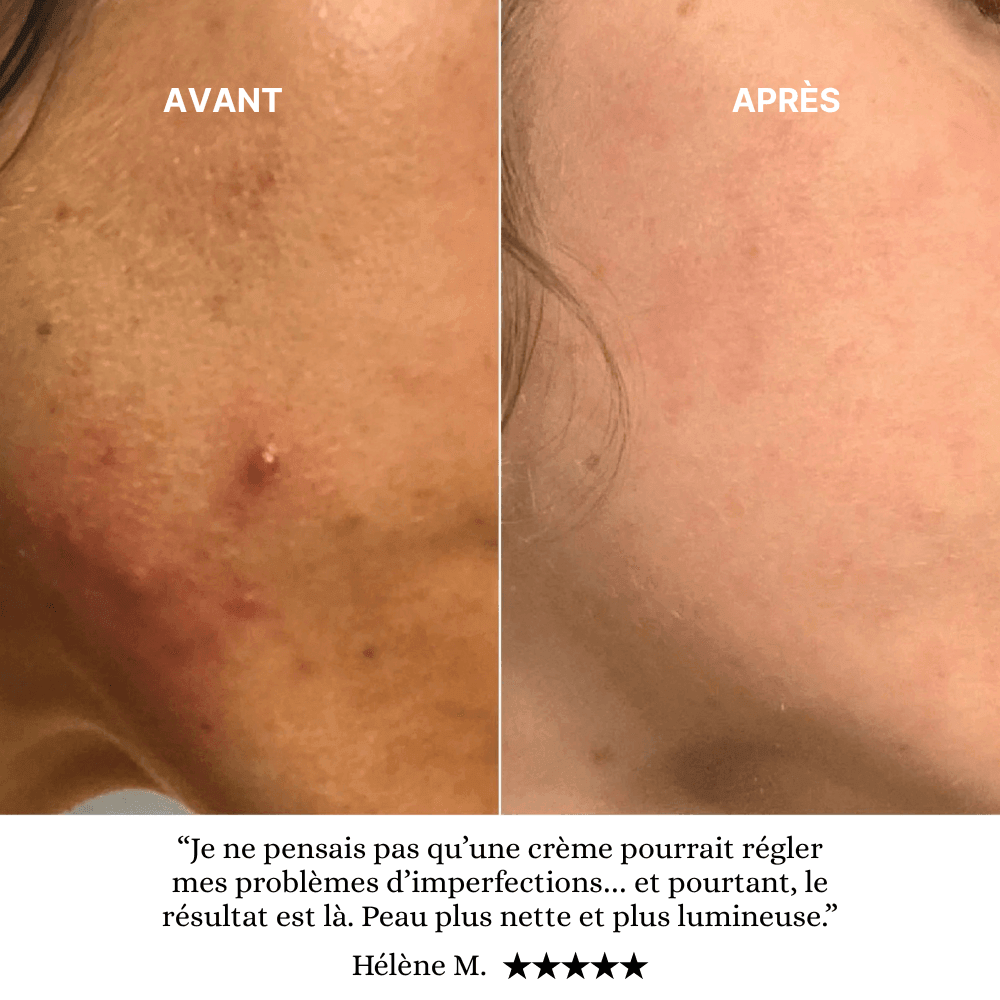 Soin Anti-Acné Ciblé