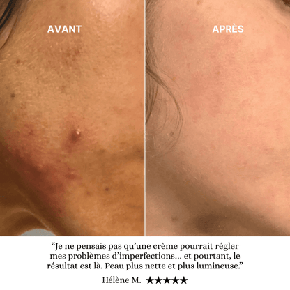 Soin Anti-Acné Ciblé