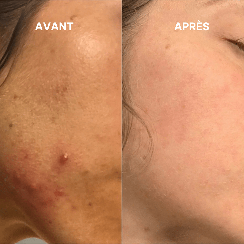 Coffret Soin Anti Acné Complet - HealSelf